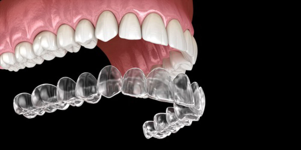 Clear aligners